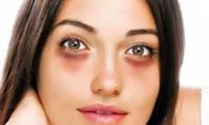 Синяки под глазами: причины и лечение недуга