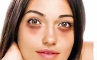 Синяки под глазами: причины и лечение недуга