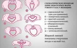 Как определяют узкий таз