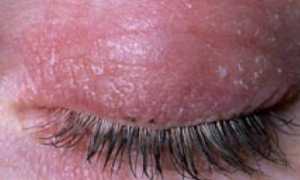 Причина покраснения вокруг глаз и способы терапии