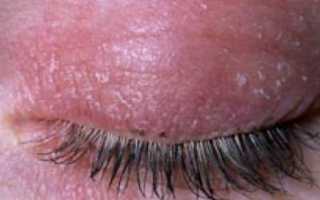 Причина покраснения вокруг глаз и способы терапии