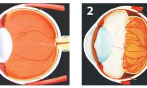 Причины отслоения сетчатки