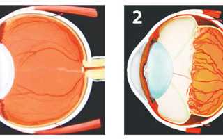 Причины отслоения сетчатки