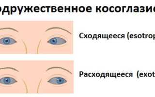 Содружественное косоглазие, лечение