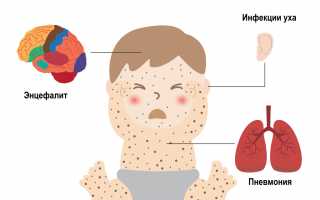 Признаки и симптомы энцефалита