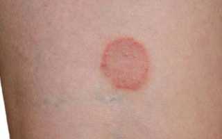 Как можно заразиться лишаем