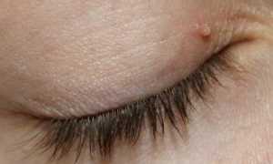 Как избавиться от папилломы на веках