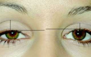 Опущение верхнего века: причины