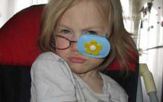 Можно ли с помощью очков вылечить косоглазие?