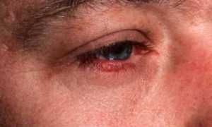 Причины возникновения демодекоза