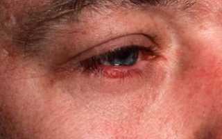 Причины возникновения демодекоза