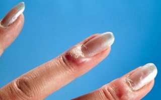 Воспаление заусенца на пальце лечение