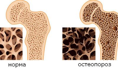 Кости при остеопорозе