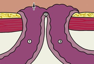 Образование свища в кишечнике
