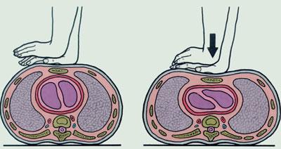 Непрямой массаж сердца