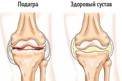 Проявление подагры