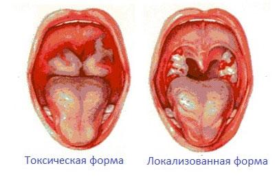 Виды дифтерии