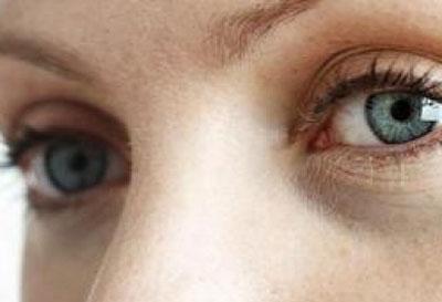 Темные круги под глазами