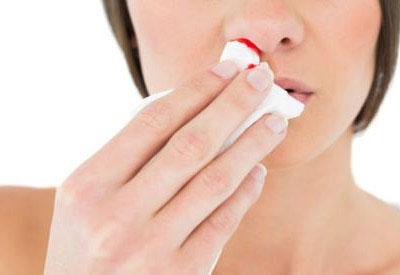 Носовое кровотечение