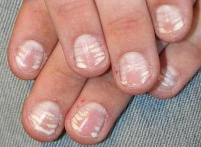 Ногтевые пластины при отравлении мышьяком