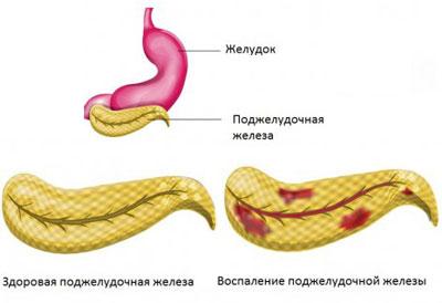 Проявление панкреатита