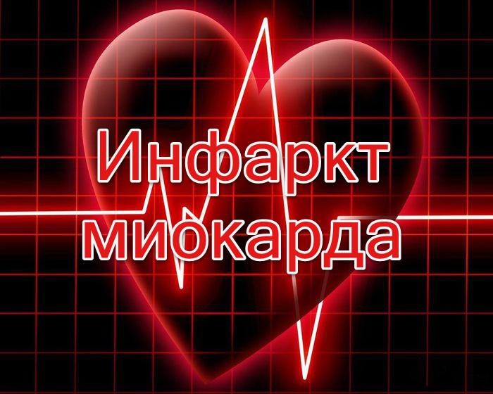Инфаркт миокарда
