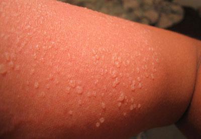 Волдыри при ожоге кожи