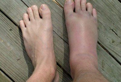 Отек ноги
