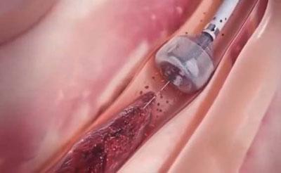 Проведение коронарографии