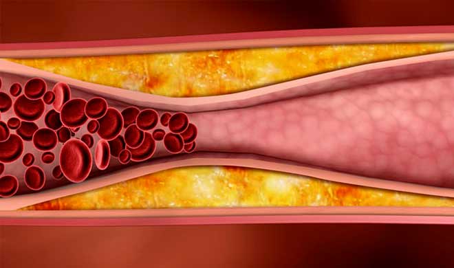 Очищение сосудов от холестериновых бляшек