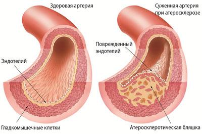 Проявление атеросклероза