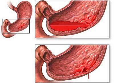 Прободение желудка