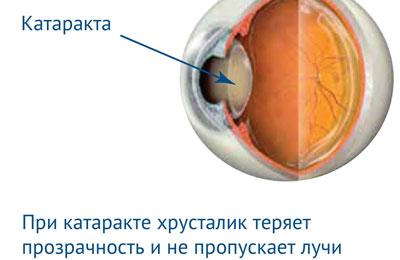 Проявление катаракты