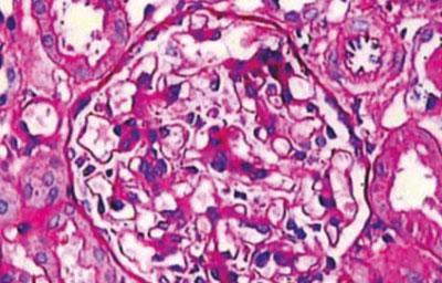 Гломерулонефрит под микроскопом