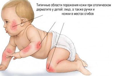 Аллергический дерматит