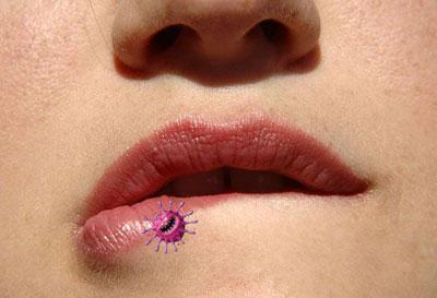 Герпес на губах