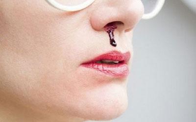 Кровь из носа