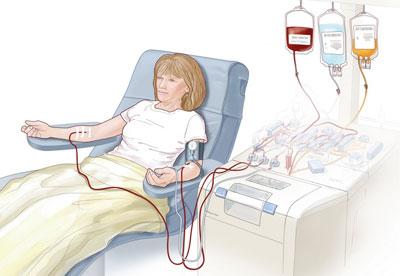 Процедура плазмафереза