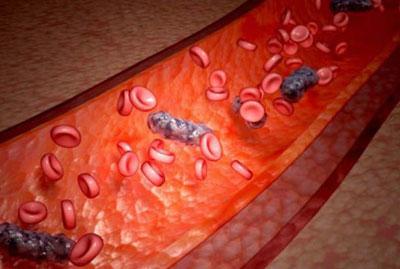 Заражение крови