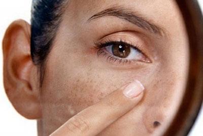 Пигментные пятна