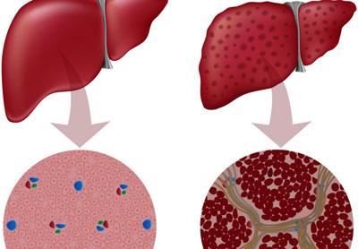 Зашлакованность печени