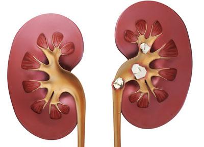 Камни в почках