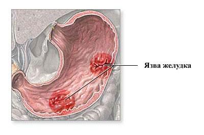 Язва желудка