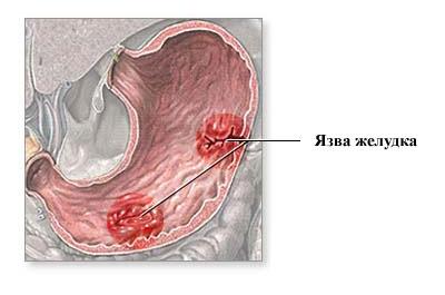 Язва желудка
