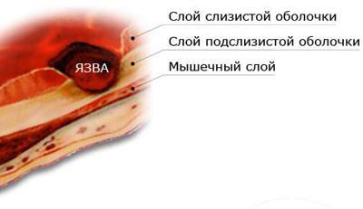 Возникновение язвы