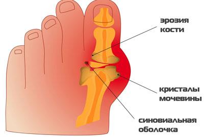 Сустав при подагре