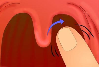 Вызов рвоты