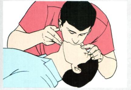 Искусственное дыхание изо рта в рот