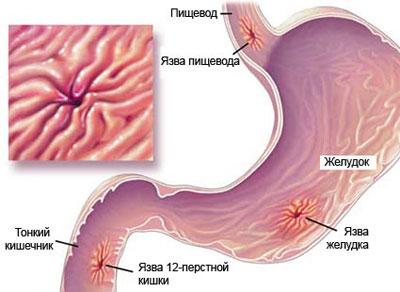 Язвенная болезнь