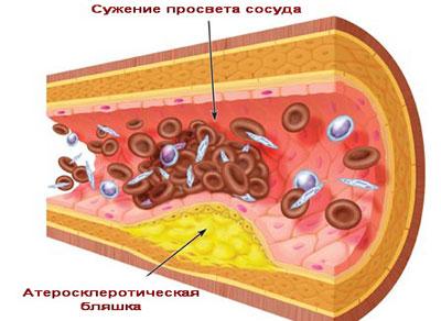 Сосуд при атеросклерозе